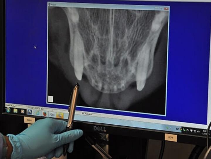Importance of Taking Dental X-rays and Dental Cleaning